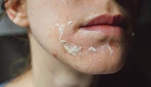 Is It Normal to Peel After a Chemical Peel?