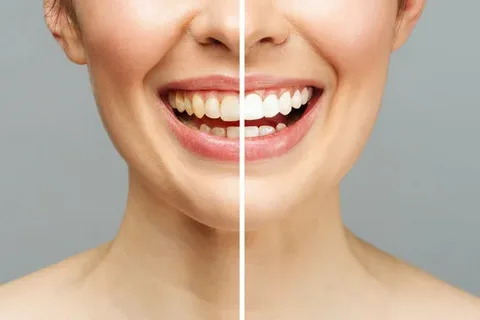 A Brighter Smile Awaits: Your Complete Guide to Safe and Effective Teeth Whitening