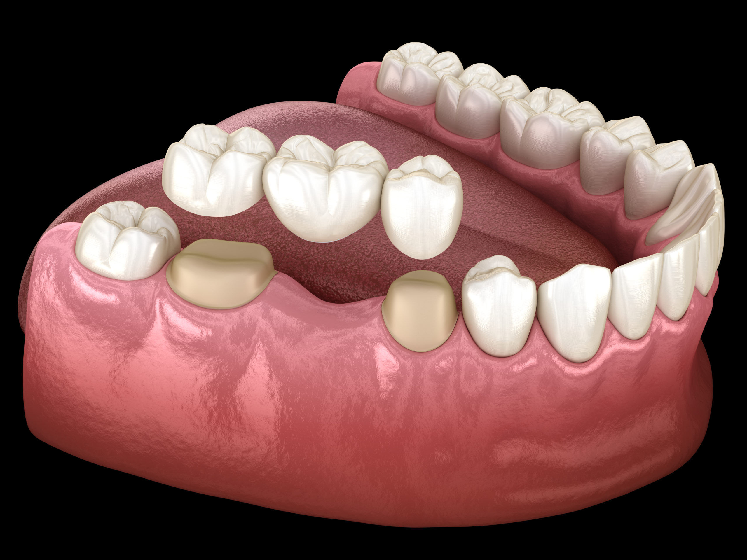 Keep Teeth Intact with Dental Crowns