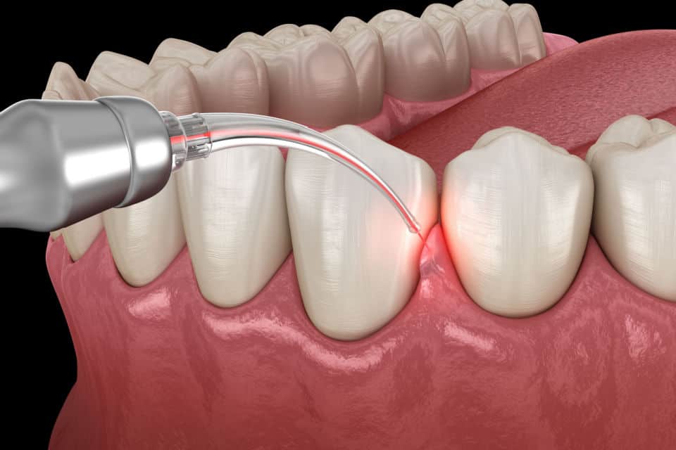 The Benefits of Laser Dentistry: Pain-Free and Precise Treatments