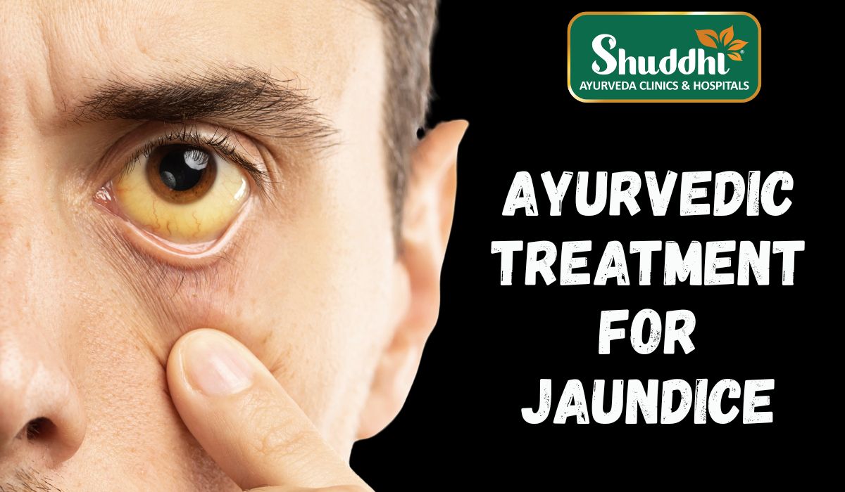 Ayurvedic Treatment for Jaundice: Natural Healing Approach by Shuddhi Ayurveda