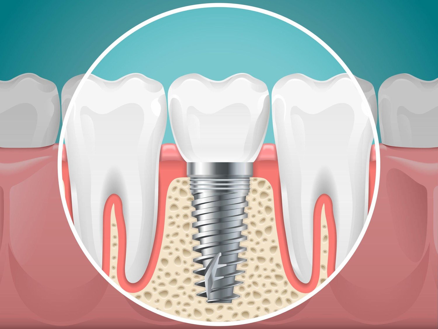 Dental Implants: What You Need to Know Before Getting One