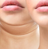 How to Prepare Your Skin for Laser Tightening Sessions