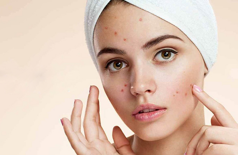 What Are the Most Effective Acne Treatment Options Today?