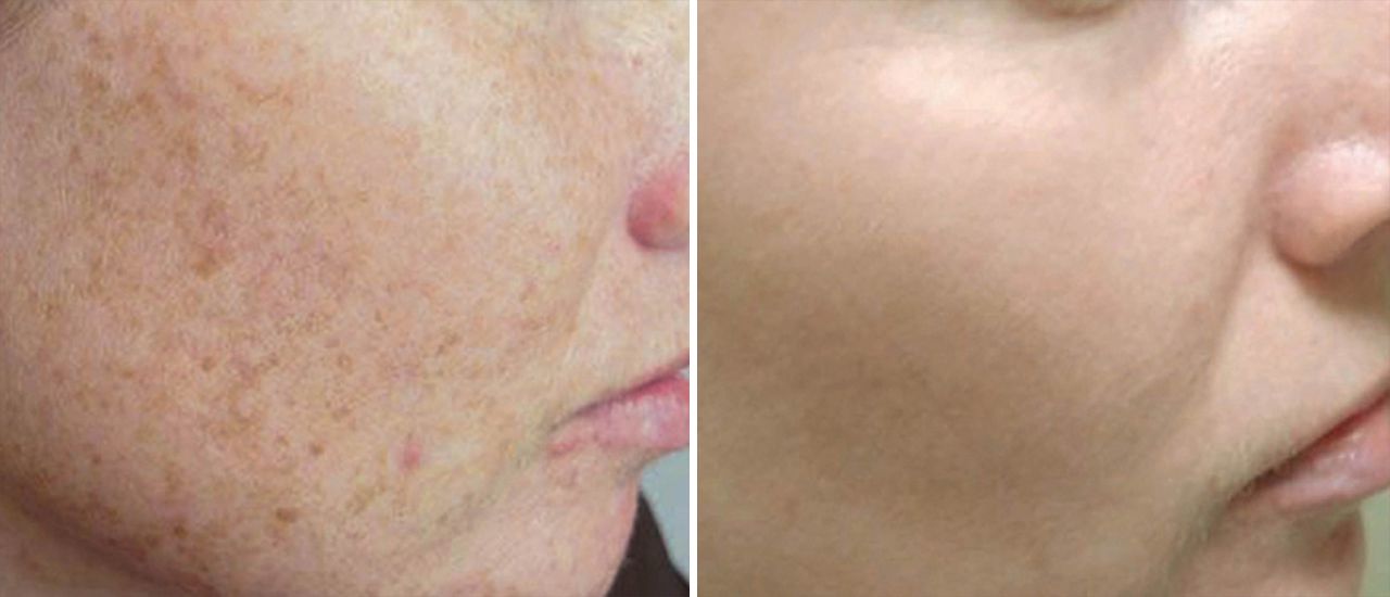 Does IPL Actually Work?