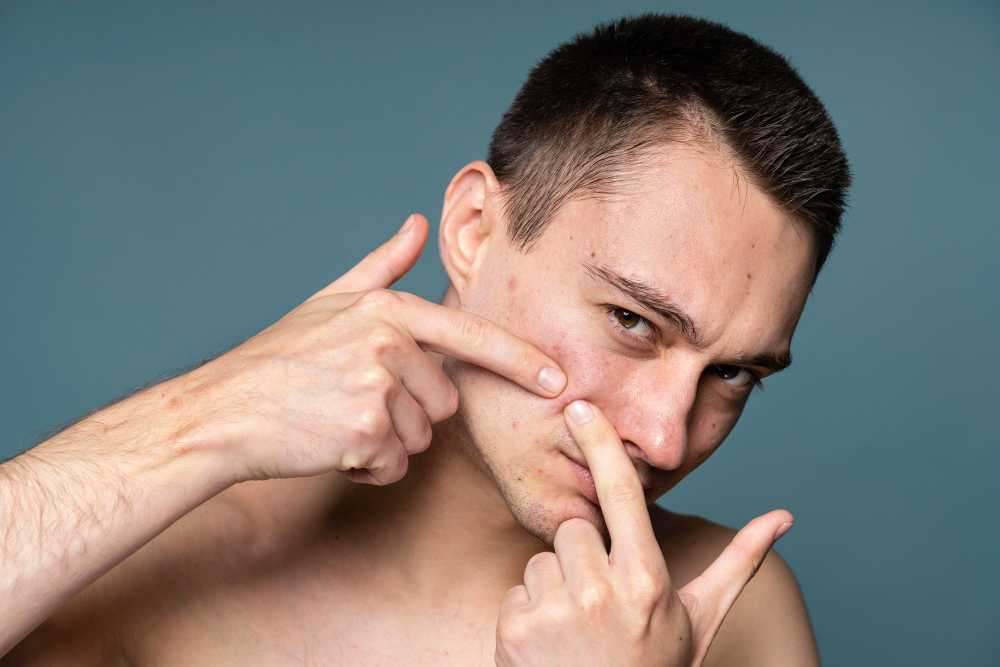 How to Get Rid of Pimples Overnight – Is It Really Possible?
