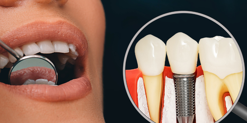 Restore More Than Just Teeth – Discover the Lasting Benefits of Dental Implants