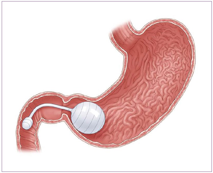 What Should You Expect The First Week After Getting A Gastric Balloon?