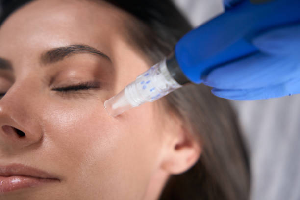 Achieve Clearer Skin with the Derma Pen