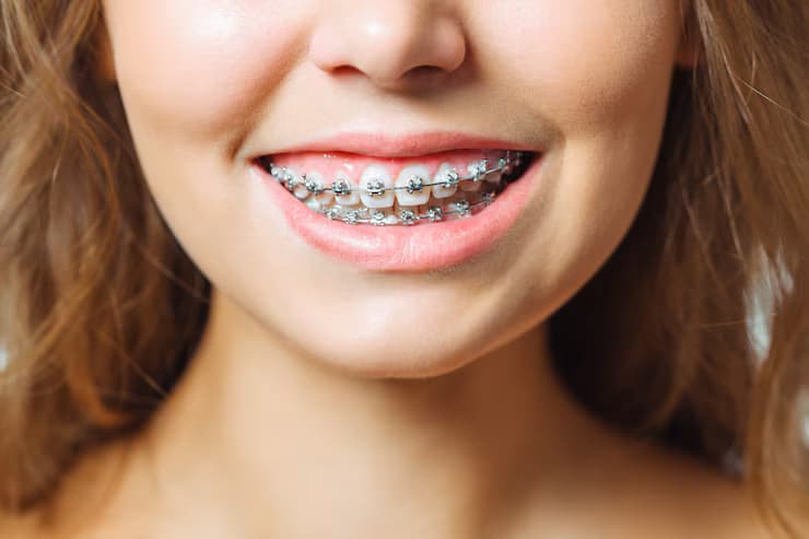 Modern Braces Aren’t What They Used to Be: What’s Changed in 2025?