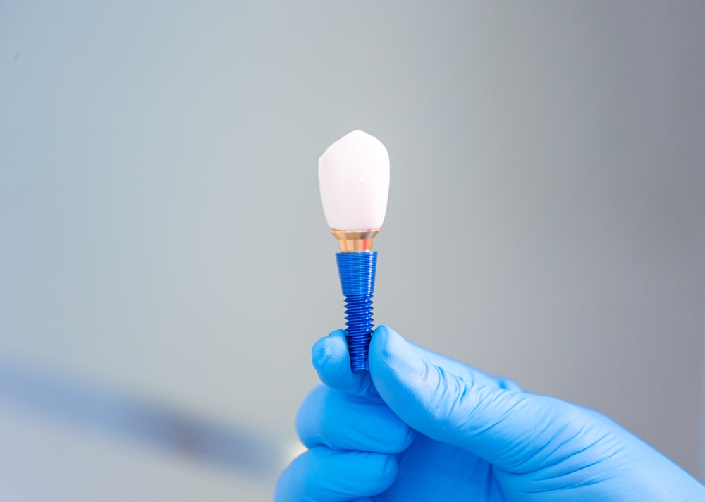 Restore Your Smile with Dental Implants Near Kissimmee