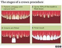 A Complete Guide to the Main Reasons People Travel to Turkey for Dental Crowns