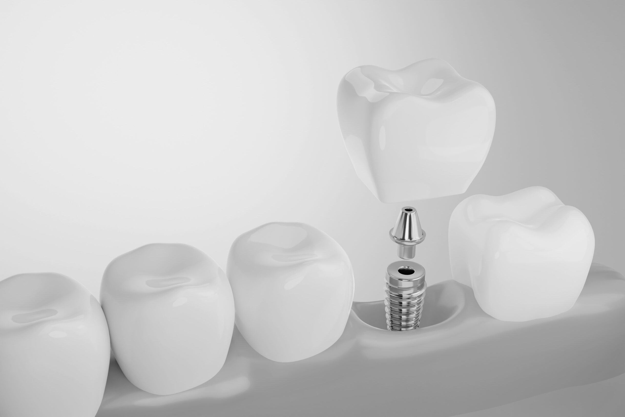 Dental Implants in Fayetteville NC: A Simple Way to Replace Missing Teeth