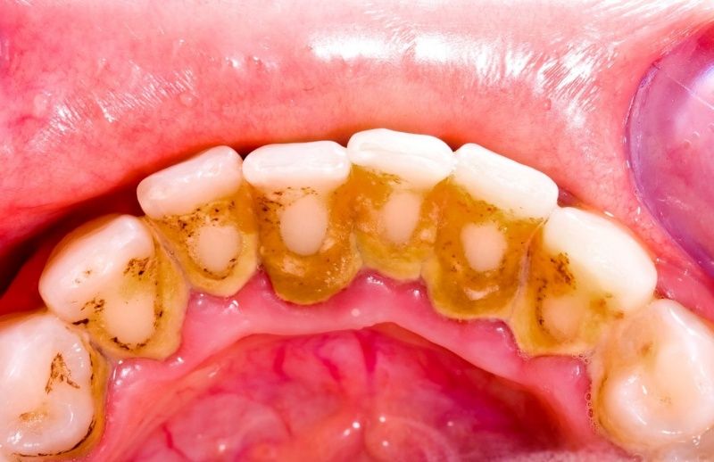 Tác hại của việc lấy cao răng: Những hiểu lầm phổ biến và sự thật cần biết