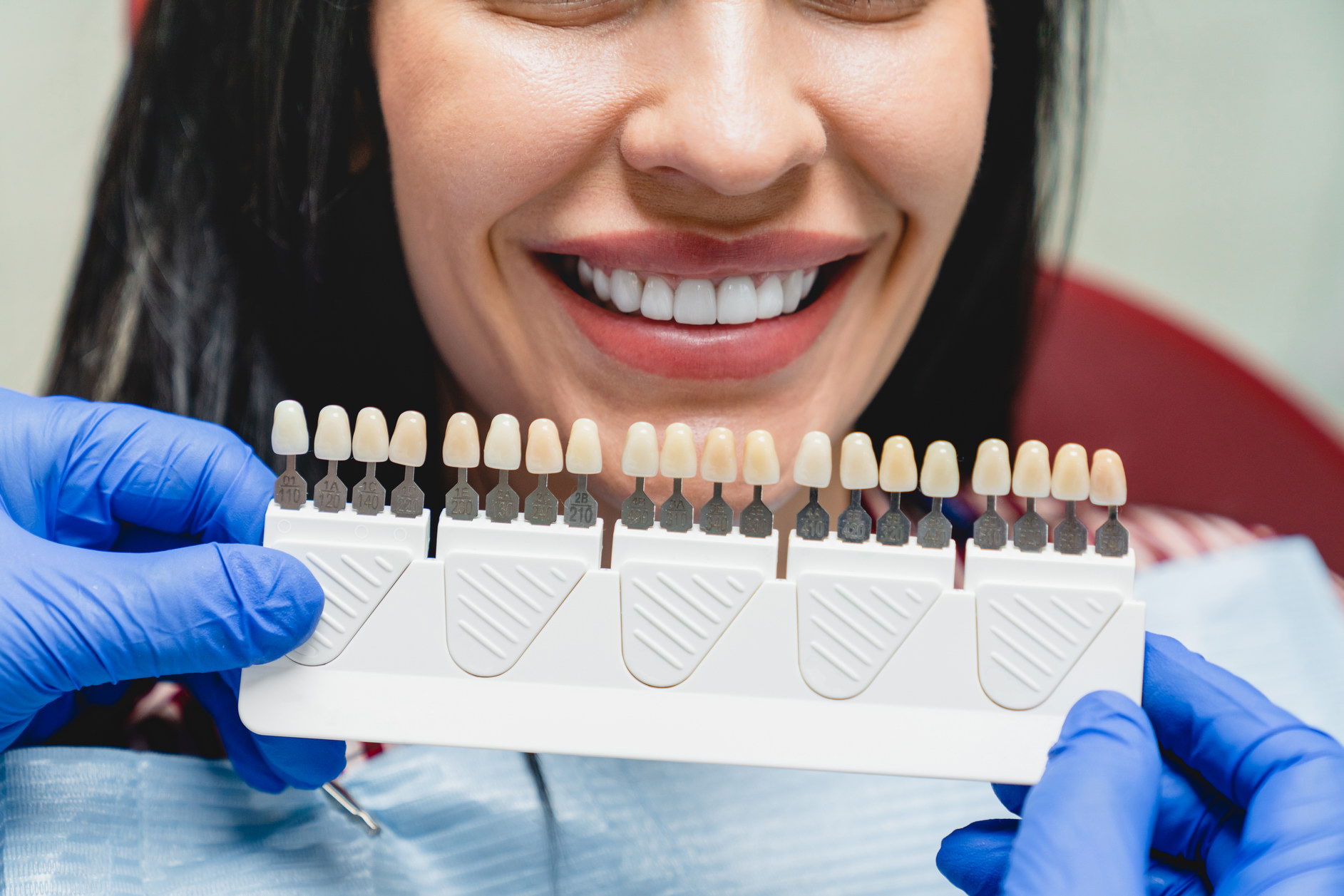 Smile Makeovers with Veneers in Islamabad: Real Results