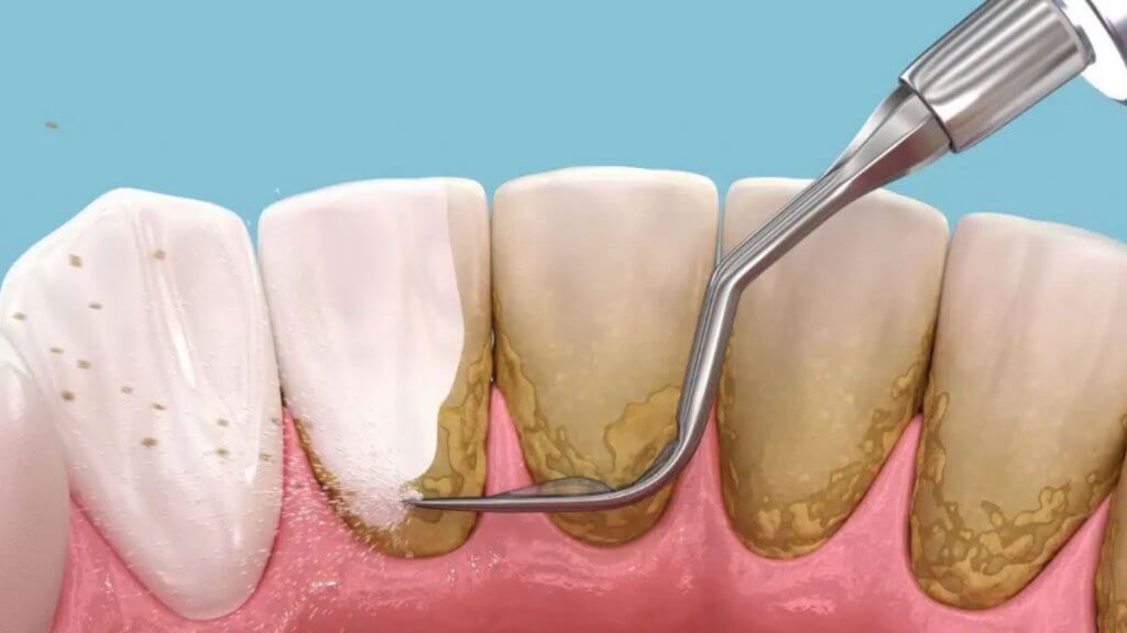 Deep Teeth Cleaning in San Antonio, TX: Protect Your Smile from Gum Disease