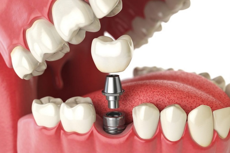 Trồng răng implant tốt nhất ở Hà Nội: Làm sao để chọn đúng nơi phục hình an toàn và hiệu quả?