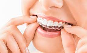How Much Does Invisalign Cost in Brisbane? A Comprehensive Guide