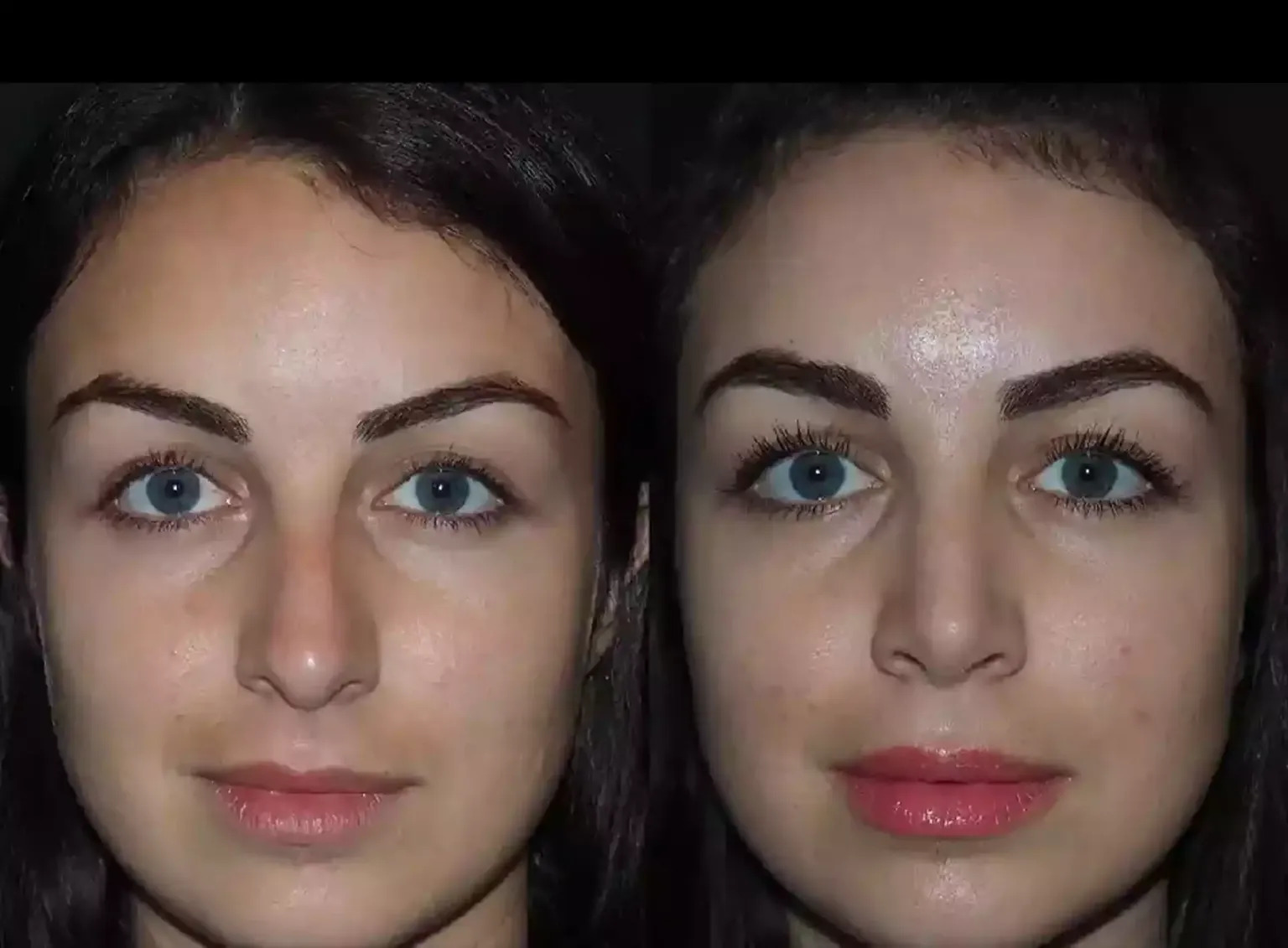 Septoplasty Myths Busted by the Best Doctors in Dubai