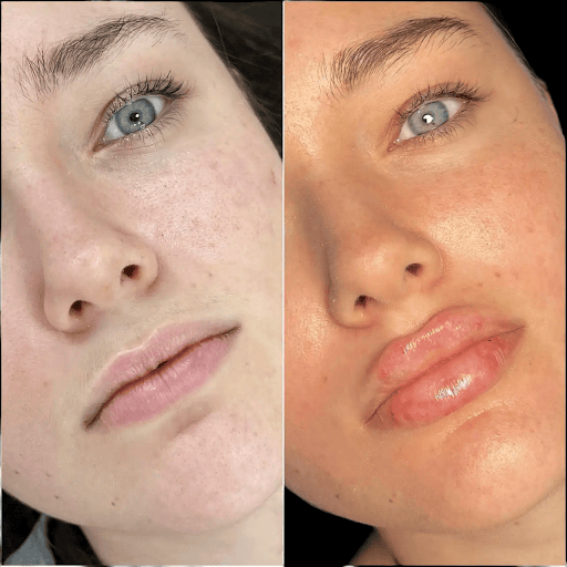 Youthful Skin Awaits with Fillers Treatments in Dubai