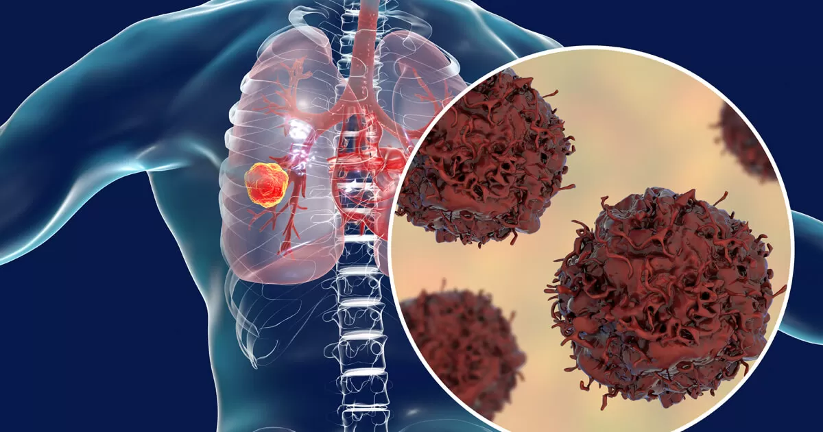 How can people reduce their risk of lung cancer?
