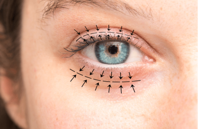 Erase Eye Bags, Revive Your Beauty with Eyelid Surgery