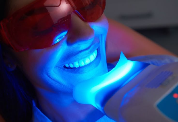 Why You Should Choose Professional Teeth Whitening Over DIY Methods