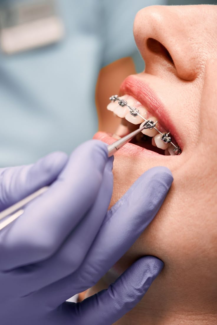 Types of Orthodontic Treatments Explained: A Complete Guide to Straighter Teeth