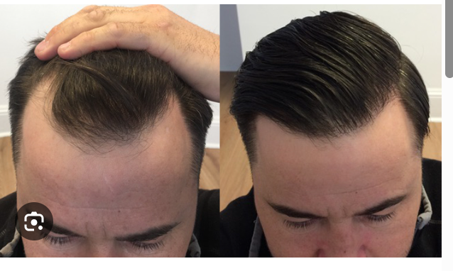 Where to Have a Hair Transplant in the UK?