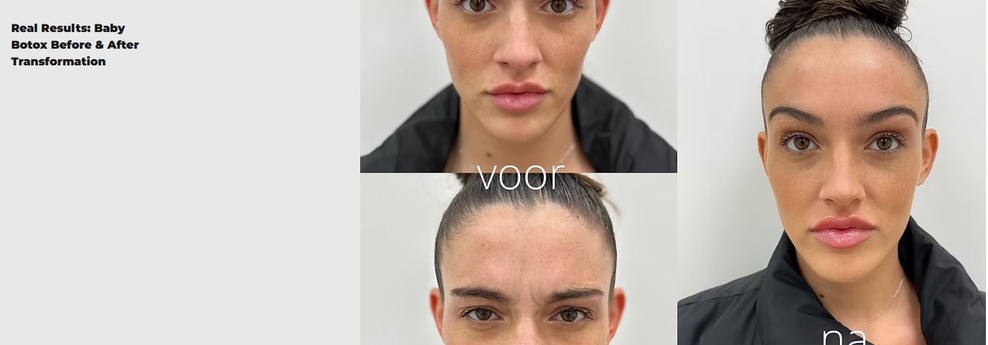 Baby Botox Explained: How It Works, Benefits, Safety, and Timeline