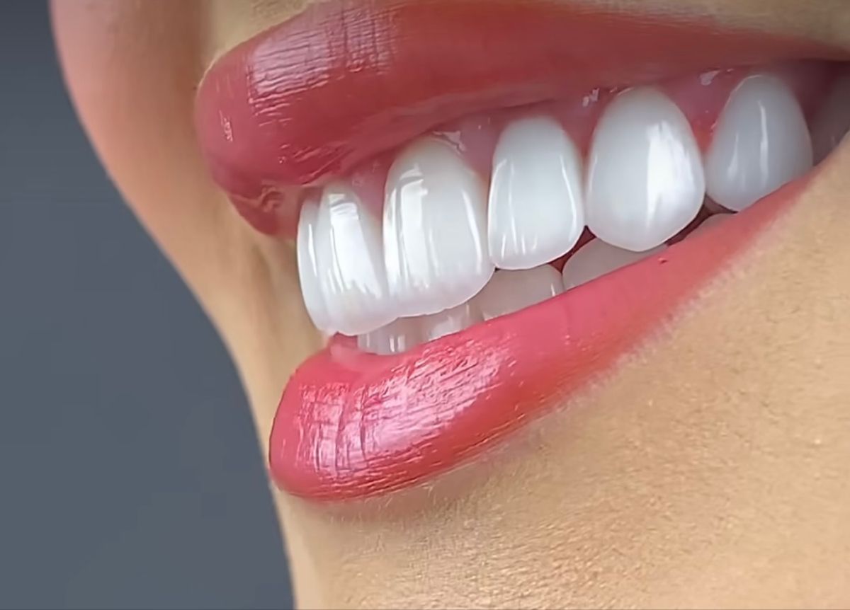 All on 4 Dental Implants: A Complete Smile with Just Four Implants