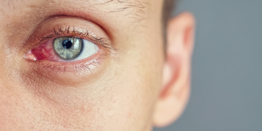 Blepharitis and You: A Caring Eye Clinic Approach