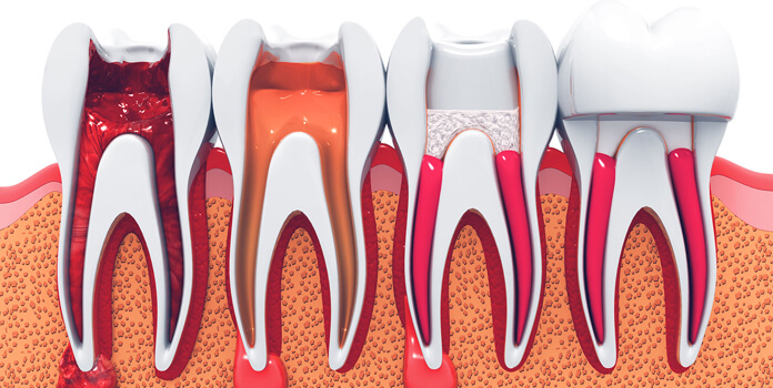 Can Root Canal Treatment Be Done in One Sitting?