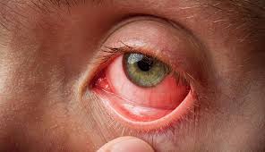What Is Conjunctivitis of the Eye and Why