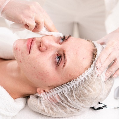 Over-the-Counter Acne Treatment: What Really Works?