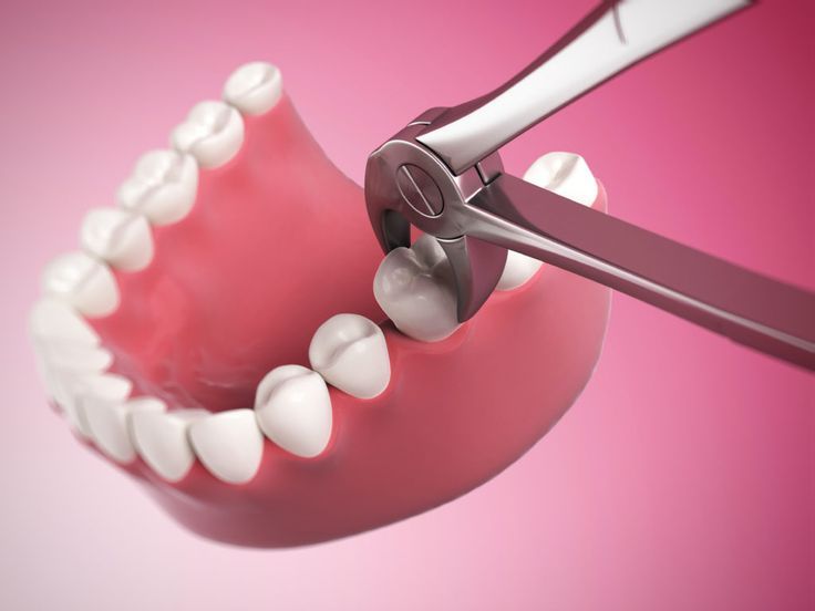 Tooth Extractions in San Antonio, TX: Comprehensive Guide to a Healthier Smile