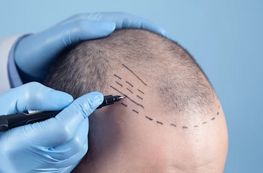 Hair Transplant in Bangalore: How to Find a Certified Hair Doctor in Bangalore You Can Trust