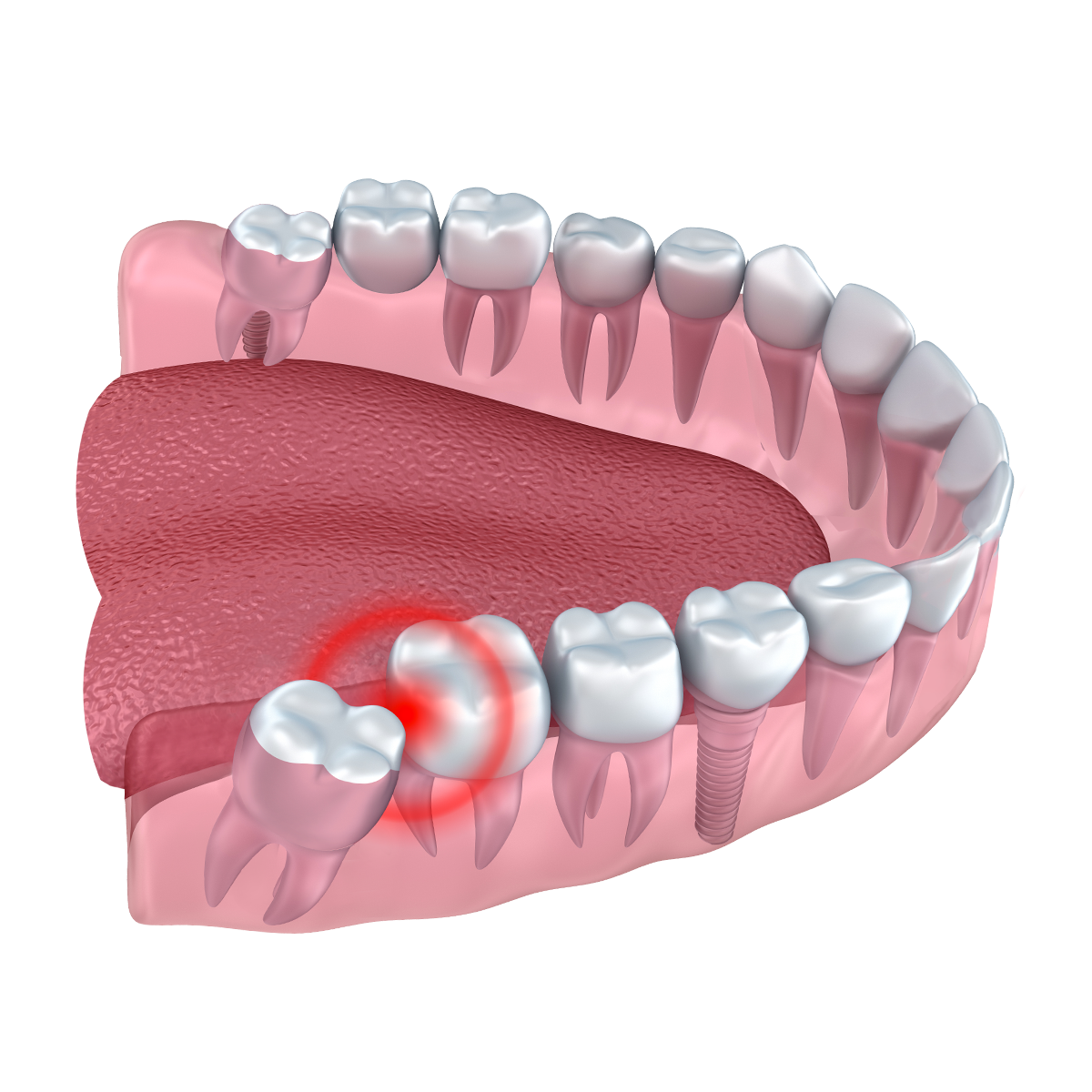How Long Is the Recovery Time for Wisdom Teeth Removal?