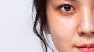 Experience Flawless Skin with Pico Laser Treatment in Islamabad