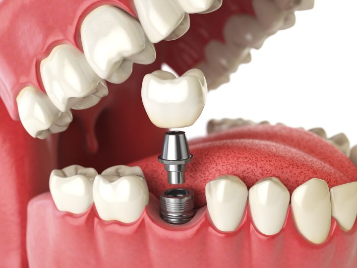What Are Denture Implants and How Do They Work?