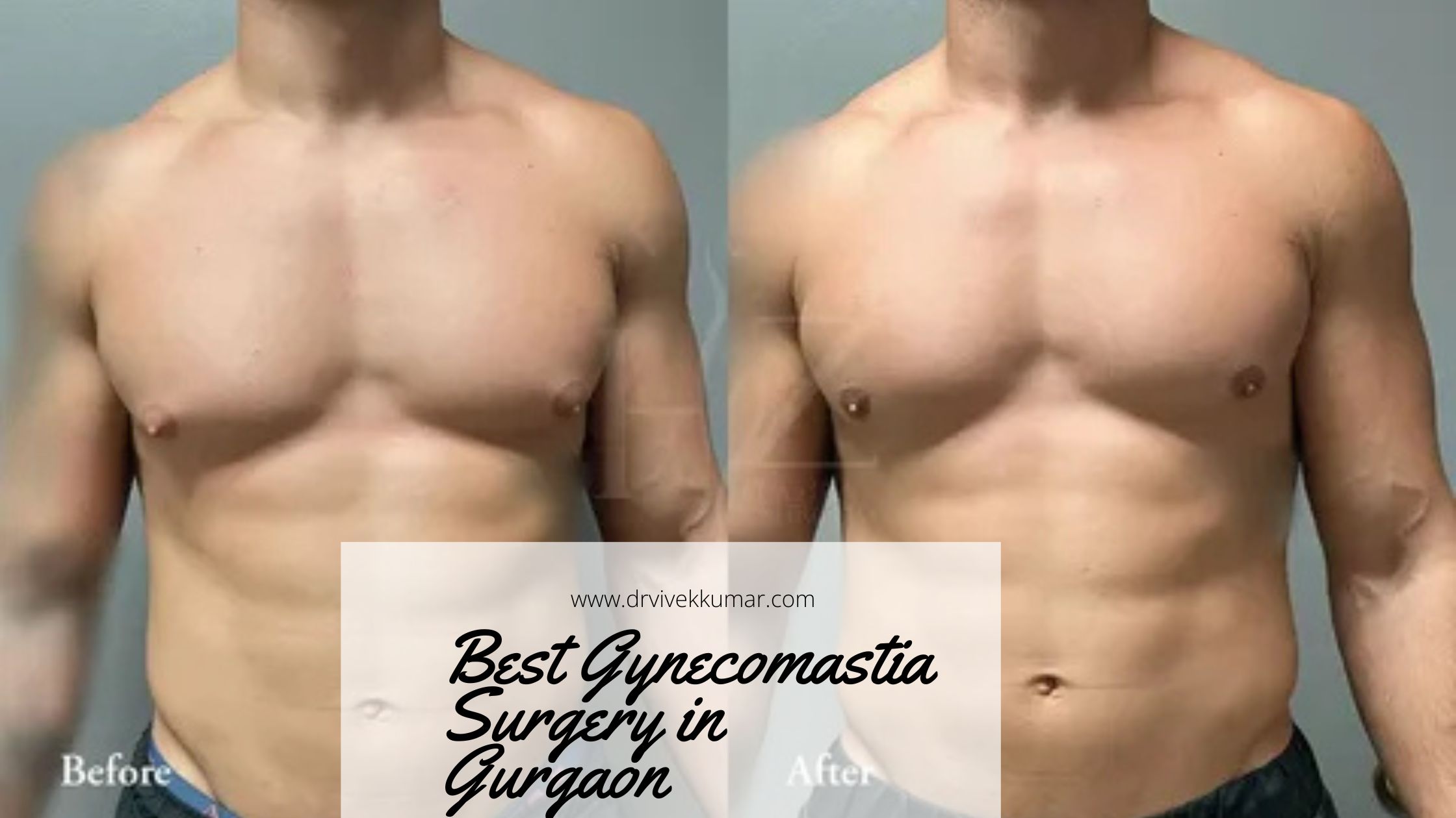 Best Gynecomastia Surgery in Gurgaon – Regain Your Confidence with Expert Care