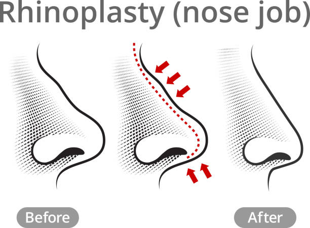 Affordable Nose Job in Islamabad Without Compromising Quality