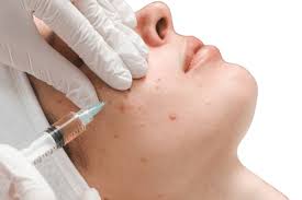 Clear Skin, Confident You: Trusted Acne Treatment in Ahmedabad, Gujarat by Dr. Krupa