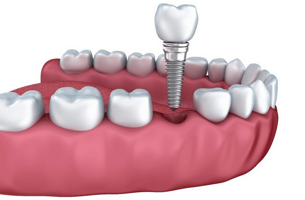 Missing Teeth Here’s How You Can Get Your Smile Back