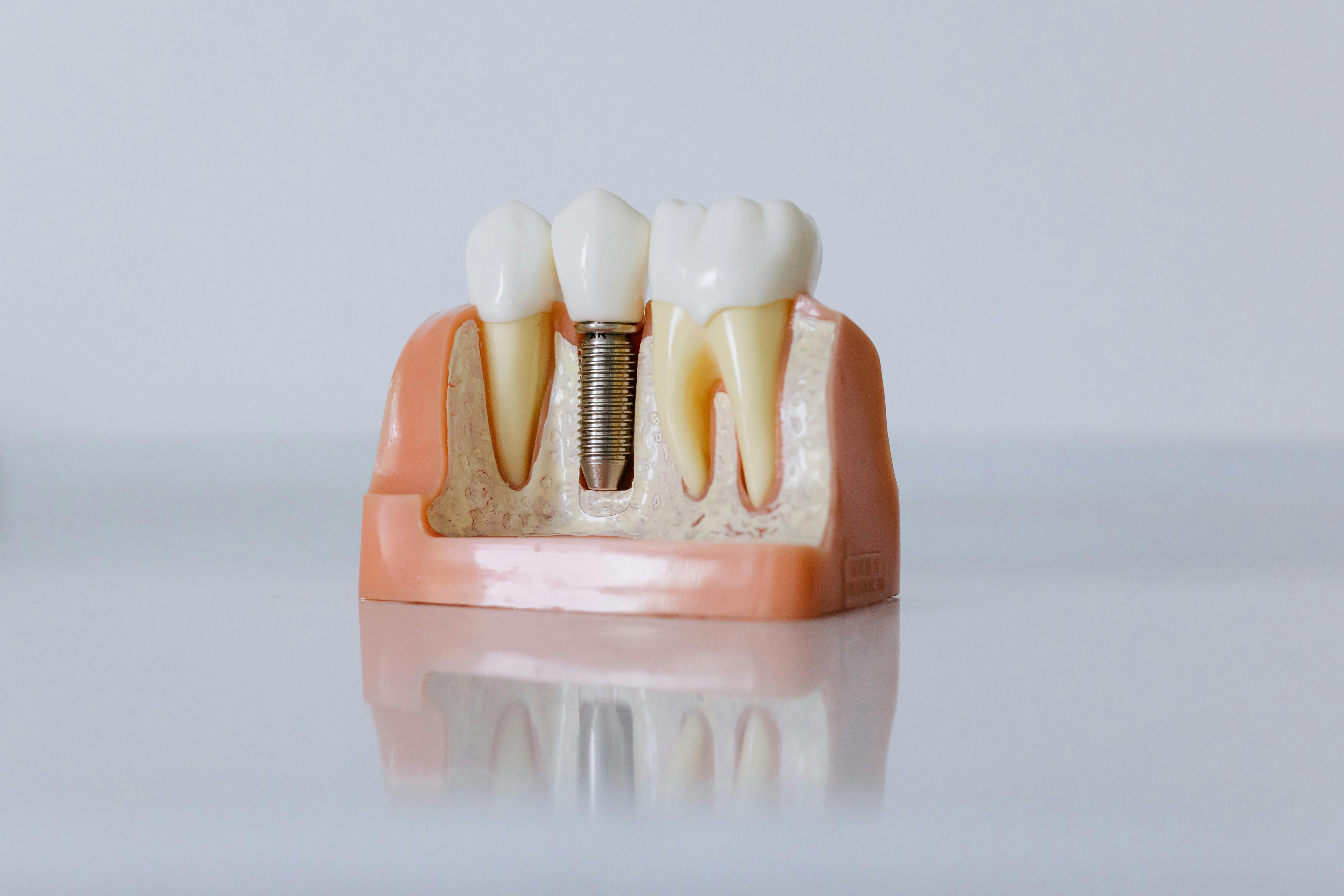 Your Complete Guide to Dental Implants