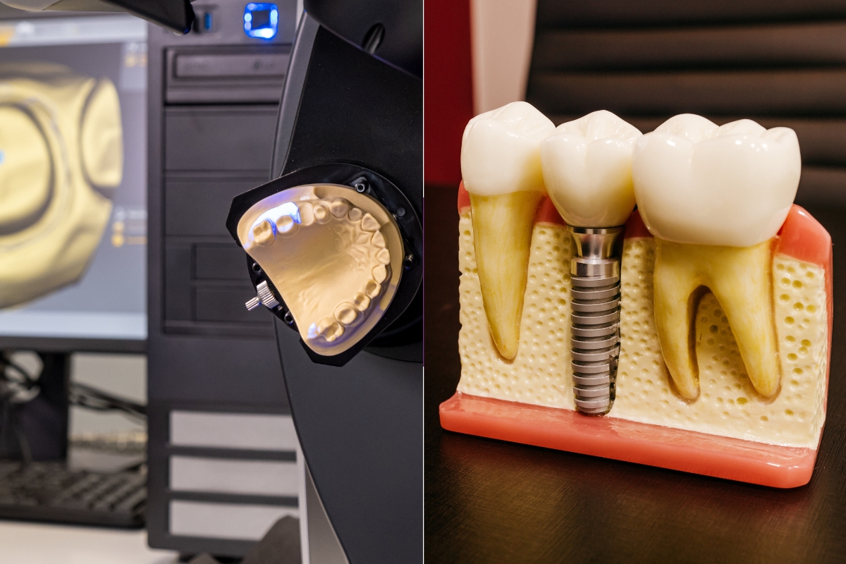 Dental CAD-CAM vs Traditional Techniques: Which Is Better?