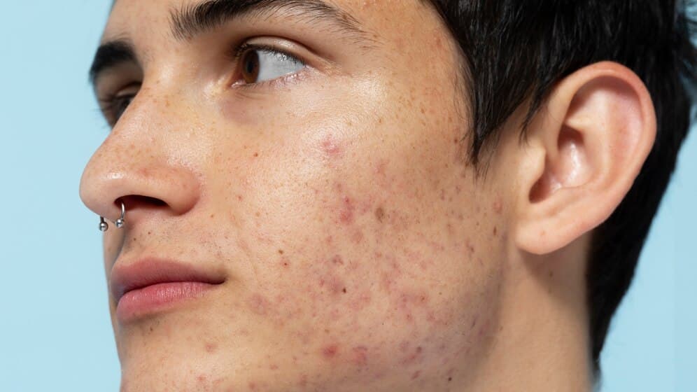 What Causes Hyperpigmentation and How London Clinics Treat It