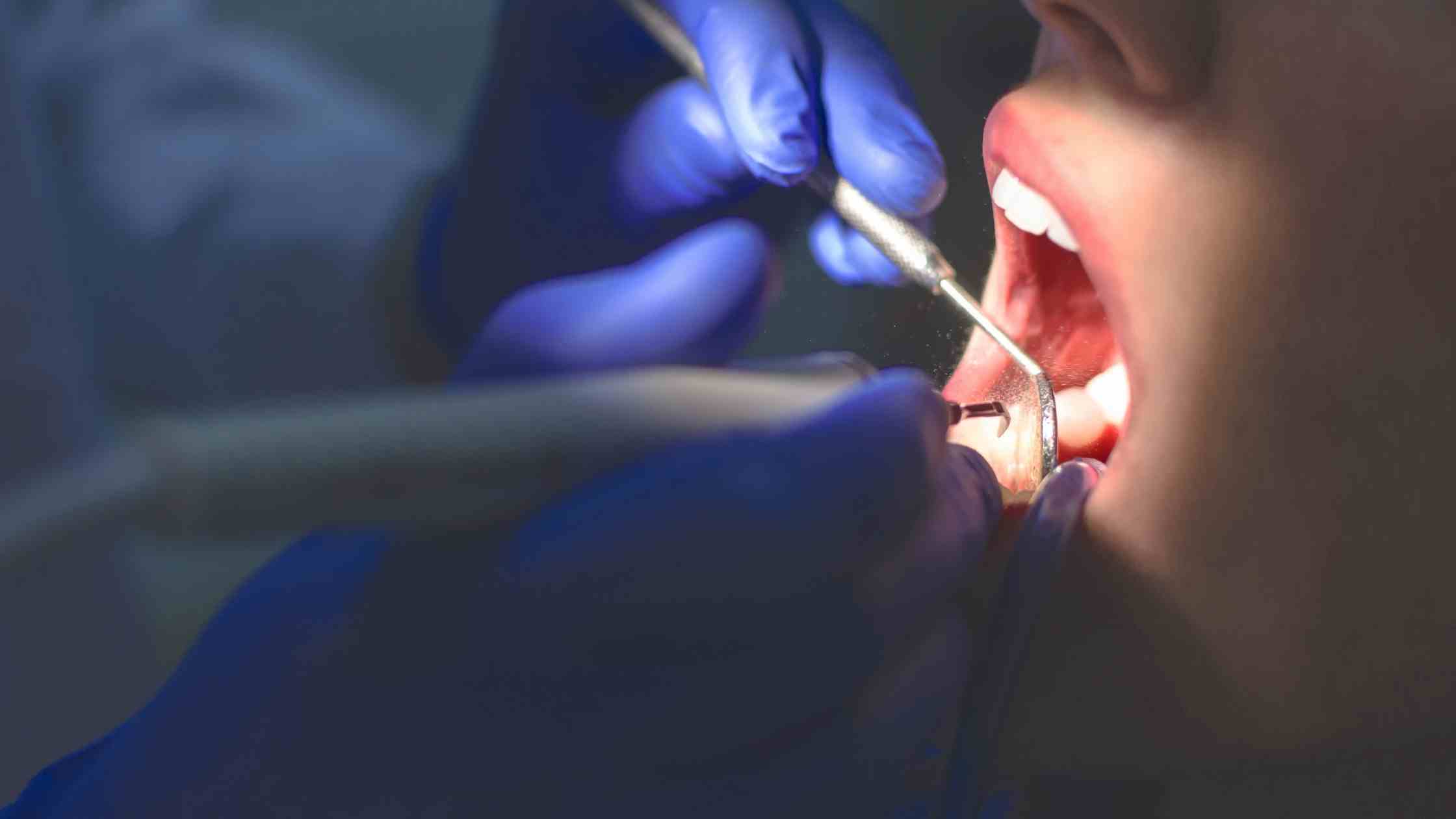 How Your Dentist Can Prevent Oral Health Issues?