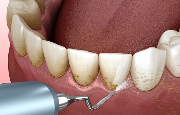 Có nên lấy cao răng – Sự thật bạn cần biết để bảo vệ nụ cười khỏe mạnh