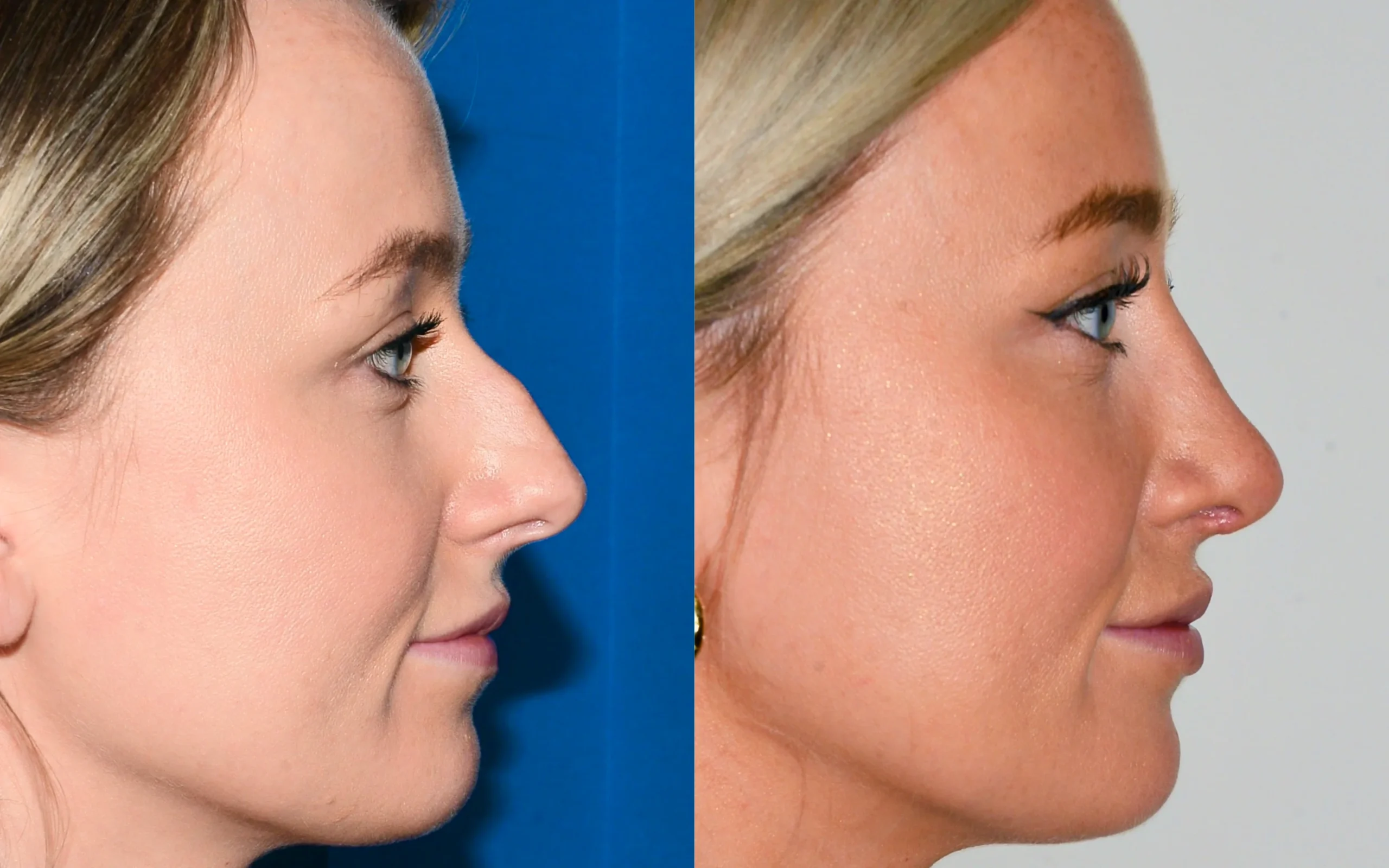 How Long Do Swelling and Bruising Last After a Nose Job in Dubai?